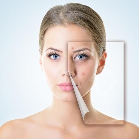 Acne Universe is the go-to source for updated acne information, treatments, and product reviews. Learn how to fight acne and keep it at bay!