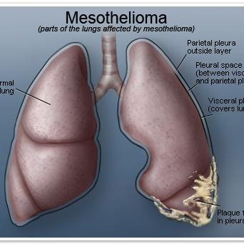 Articles and information about mesothelioma cancer