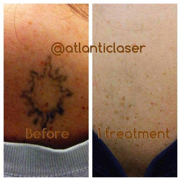 We are Virginia's leader when it comes to safe and effective laser tattoo removal. Call 757-340-4663 for a free consultation today!!