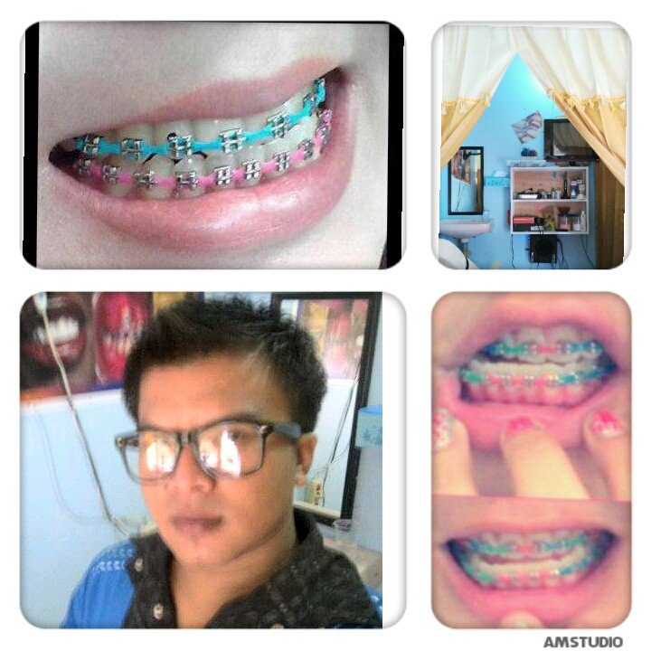 Melayani pasang Behel & gigi palsu: [Pin. 2BA3670F]