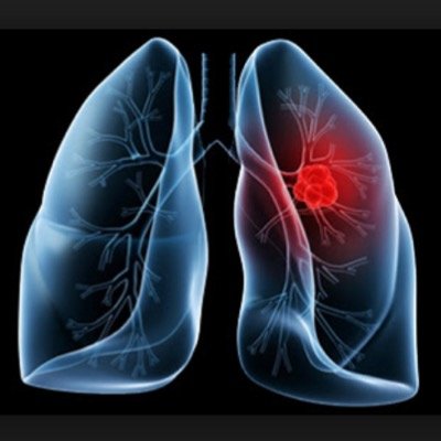 Rising Awareness For Lung Cancer In Patients Around The World.
