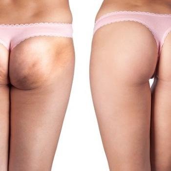 Focused Trainers On cellulite removal, We have great methods to kill cellulite in under a month. Stay tuned to know morehttp://beautyinspector.com/category/cell