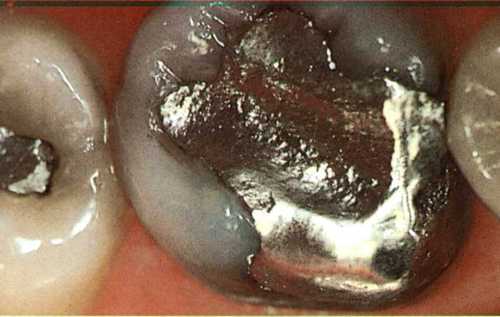 MercuryAmalgam's profile picture. Mercury Poisoning - The Truth About Silver Fillings. Diagnosis and Treatment of Mercury Poisoning.