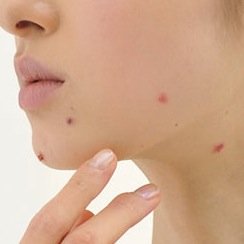 ツラいニキビの改善、対策を様々な角度から発信していきます。フォローお願いします。