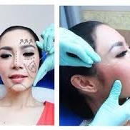 kami adalah tempat klinik dokter tanam benang/ threadlift dan filler di jakarta, menjadikan hidung mancung, pipi kencang, Telp. 081288822262 pin BB :512942DE