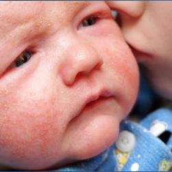 Tips and information about eczema.