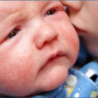 Eczema Tips (@eczema_tips) 's Twitter Profile