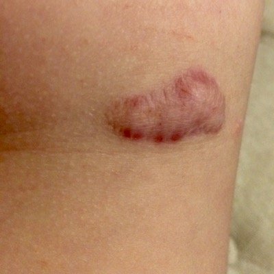 BupaHurts's profile picture. Dr. Elliot Benjamin performed a tonsillectomy on my 3 year old son two years ago and burned his leg while he was unconcious.  BUPA's lawyers refuse to settle...