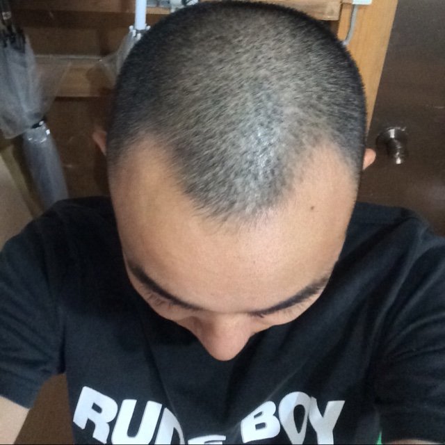 AGA治療中