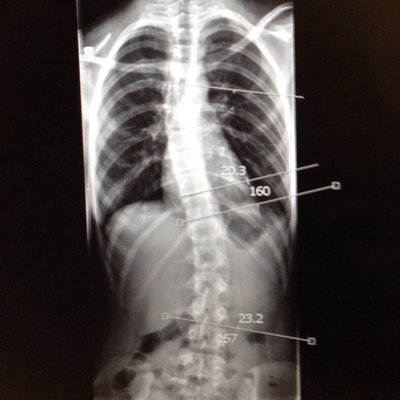 im 13 years old and have scoliosis. i have to wear a boston brace 22 hours a day. my curve is 29 on the top and 34 on the bottom.