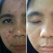 Kulit Putih Cerah, Bebas Jerawat dan Flek Hitam | SOLUSI KECANTIKAN ALAMI | Tanpa Bahan Kimia | INVITE 24EA7E75 | WA 081910635447