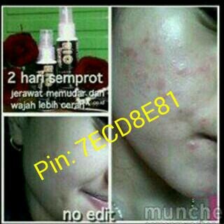 BIO SPRAY GOLD

50.000 Wajah Bebas Jerawat Dan Flek Hitam 081212121558 Pin:7ECD8E81