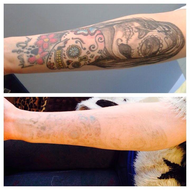 Fotona Tattoo Removal Lancashire the best machine at great prices call 01772792211 for more information