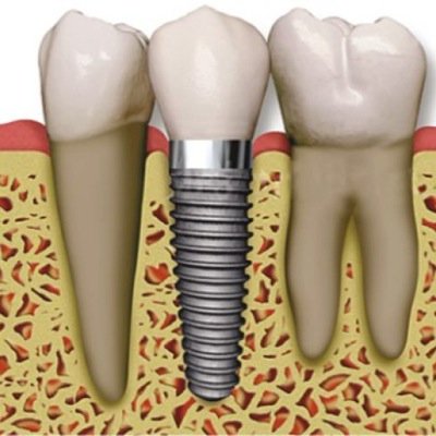 Dental Implants have revolutionized field of dentistry. I fell in love with them in the 90s and had them mastered by mid 2000s after successfully placing 1000s!