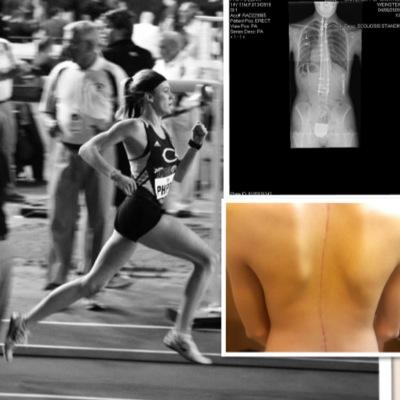 Scoliosis surgery 2009. College Track athlete. How to be an athlete after spinal surgery. Check out my blog: 
https://t.co/QKtqxZkBJS