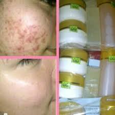 WBCreamReady's profile picture. #Mengatasi masalah kulit di wajah terutama masalah jerawat