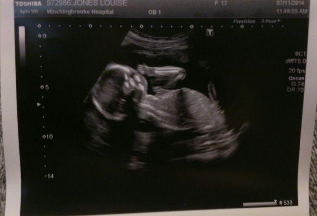 17,Pregnant,5sos,janoskians