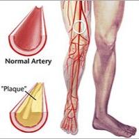 Protease-activated receptor-1 (PAR-1) antagonist; 2.08mg PO, Q24hours, thrombotic risk reduction AFTER: MI when PAD