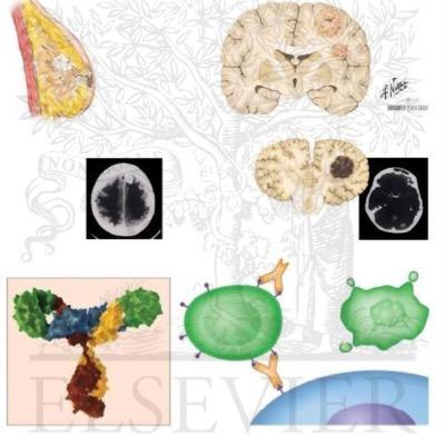 AntiCD52 cytolytic mAb for relapsing Ma