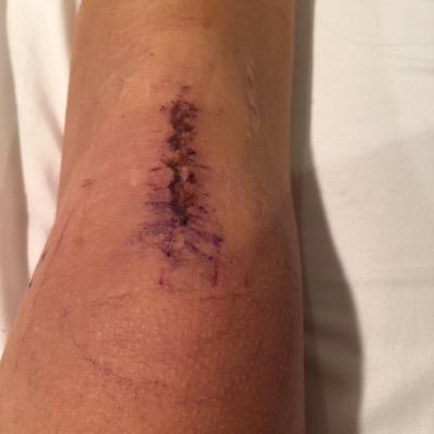 AclCombat29's profile picture. Just a soccer player who tore her left acl twice ✌️ 
surgery 9/19/13 & 11/26/14⚽️