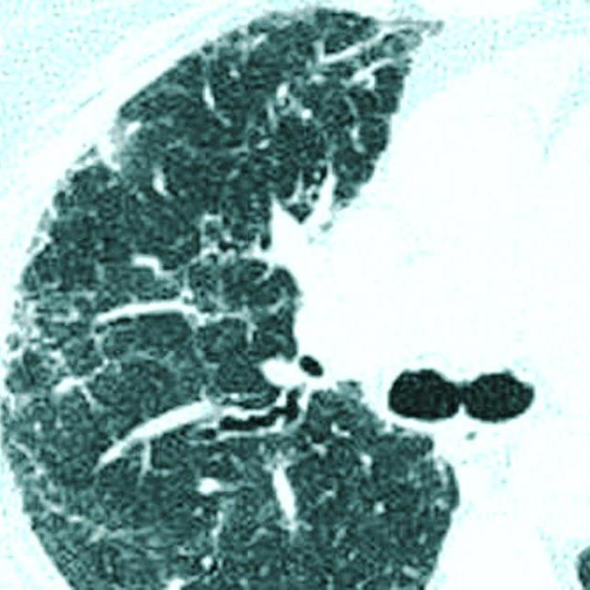 Respiratory Physician: tweets on #PulmonaryFibrosis  #Sarcoidosis #COPD; focus  #RespiratoryPhysiology & #Exercise #Physiology  דר' סמיר נסייר