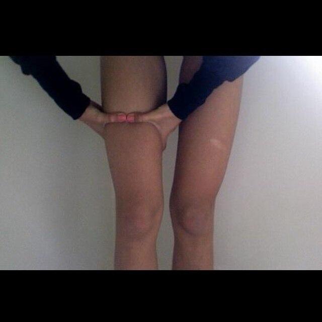 anorexic . cw 84lbs . gw 70lbs . depression . 14