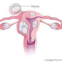 Fibroids No More