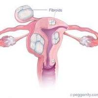 Fibroids No More (@fibroidsnomore) 's Twitter Profile