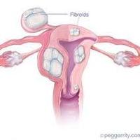 Fibroids No More(@FibroidsNoMore) 's Twitter Profile Photo