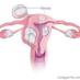 Fibroids No More (@fibroidsnomore) Twitter profile photo