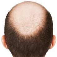 Alopecia No More (@alopecianomore) 's Twitter Profile Photo