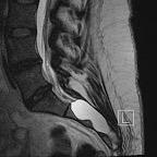 Advocates for the rare, controversial and debilitating spinal cord disease known as Tarlov Cyst Disease.