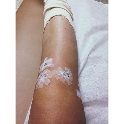 torn ACL, partially torn meniscus, and a cracked bone while playing soccer!! had surgery & on the way to recovery