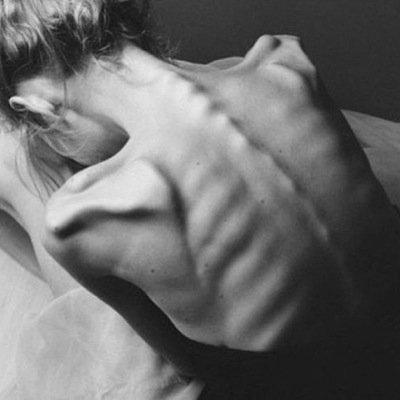 14 depressed and calorie obsessed