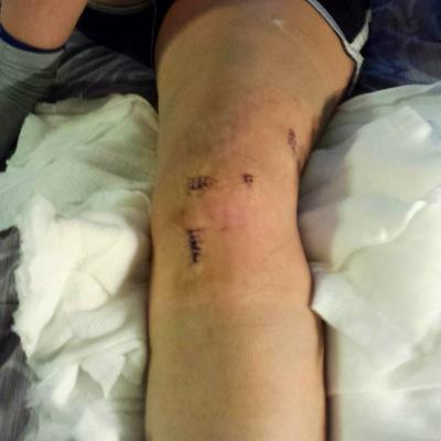 Just a minor setback for a major comeback! Torn ACL and meniscus October 6, 2014.
DM us if you wanna talk!