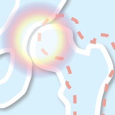 We conduct research into paediatric hip conditions at Cardiff University, and aim to raise awareness of these conditions.