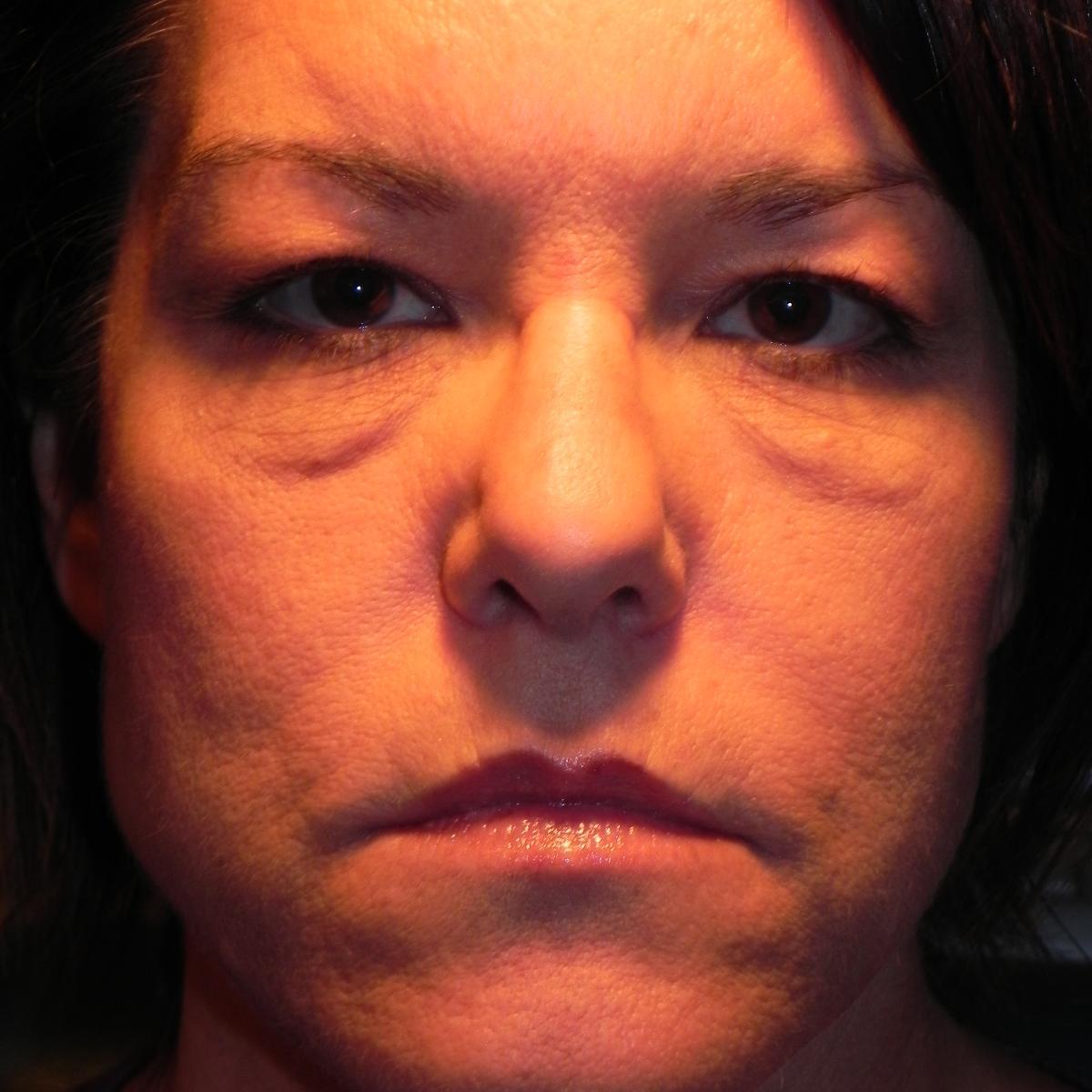 Laser Eyelid and Facial Plastic Surgeon