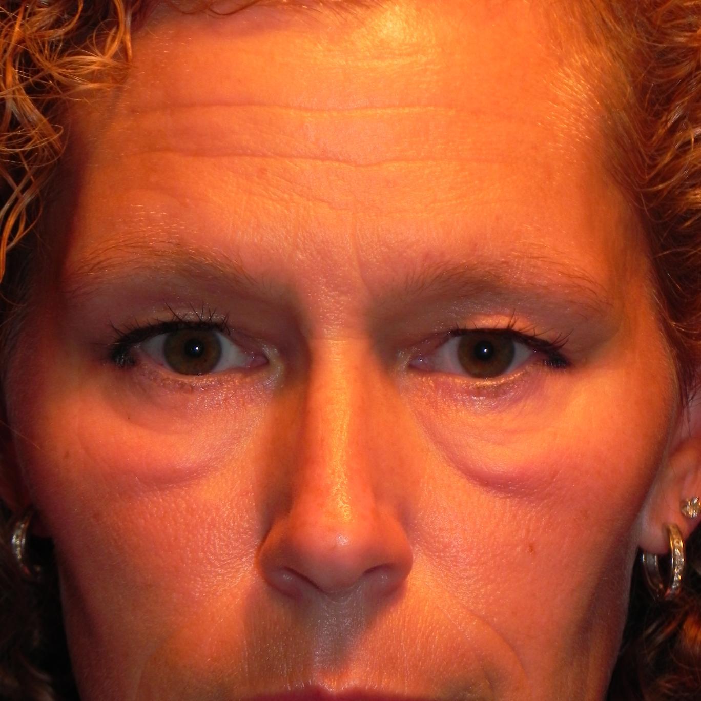 Laser Eyelid and Facial Plastic Surgeon