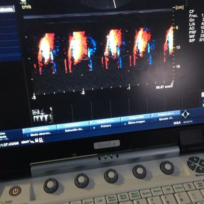 Adult and pediatric Intensivist. Blog about echocardiography in critical care.#CriticalUltrasound #Ultrasound #Echocardiography #ICU #POCUS