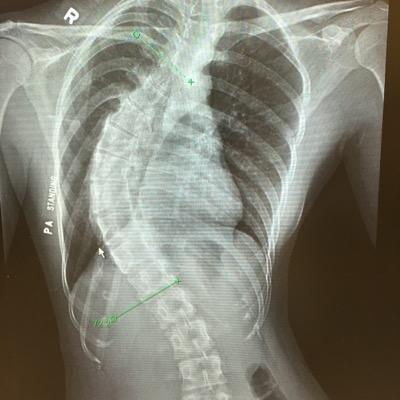 On 26 April, I shall be running in the London marathon to raise money for research into Scoliosis. This is a condition that affects millions of people worldwide