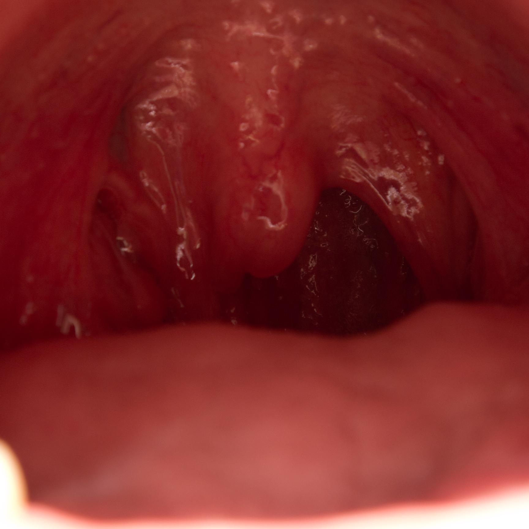 TonsilStoneTV's profile picture. YouTube channel with 2.5M+ views! Get rid of #TonsilStones. Partner with us: e-mail: tonsilstonetv@gmail.com DISCLAIMER: http://t.co/qIVCBZtRYm