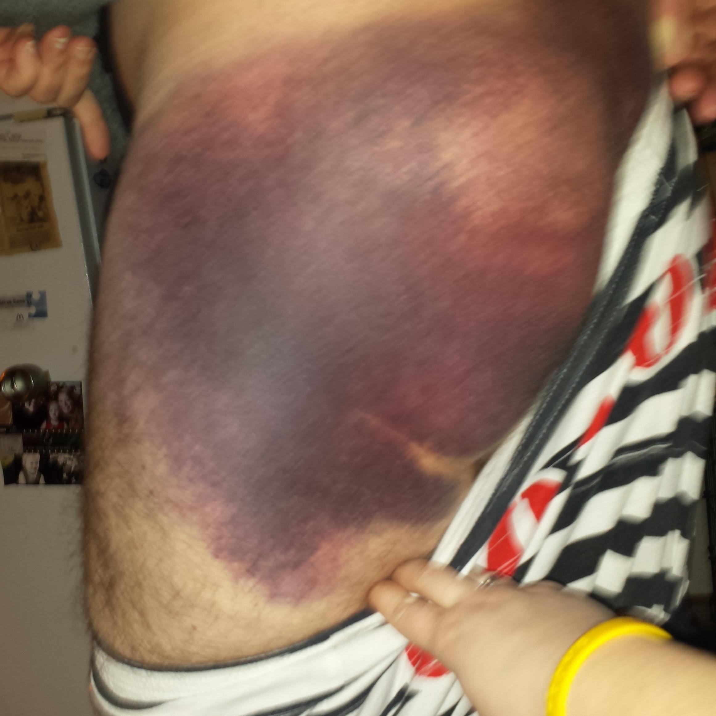 nenshibruise's profile picture. I'm swollen and I LOVE purple, lean hard to the left and can be quite taxing.   I also live in a basement and am the World's Best Bruise