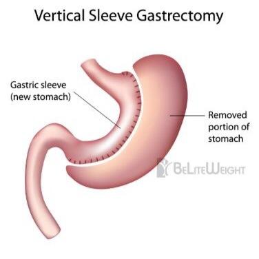 dixieVSG's profile picture. I'm having a vertical sleeve gastrectomy on 3/16/15