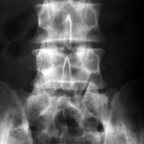 Addressing Chronic Lower Back Pain. Lower spine manipulation to reduce back pain. Find the best back pain doctor for spinal advice.