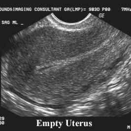 Finishing up Round 2 of IVF / FET ~ Round 1 = FAIL ~ Endometriosis ~ TTC for 2 years ~ I'm documenting our TTC journey.