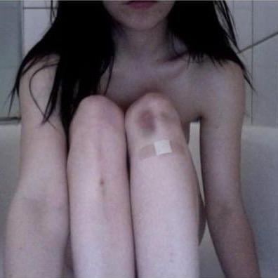 I'm E. I'm 20, OCD, ED, Depression; 6ft - Starting Weight: 175lbs CW: 155lbs GW: invisible #skinny15