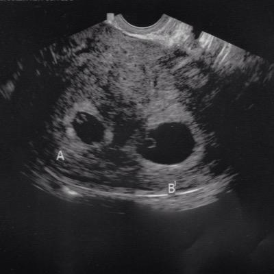 Im a fetus, my twin is @Hope_Locksley. I'm A, and she's B. Our parents are @TheHot1_Twinies and @Smorgasms.
My big brother is @TruestBelieve