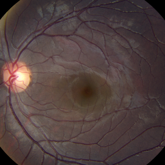 RetinaJC's profile picture. Monthly online twitter chat discussing recently published retina research articles. Asynchronous over 48 hours. 1st JC planned for April 2015. #retinaJC