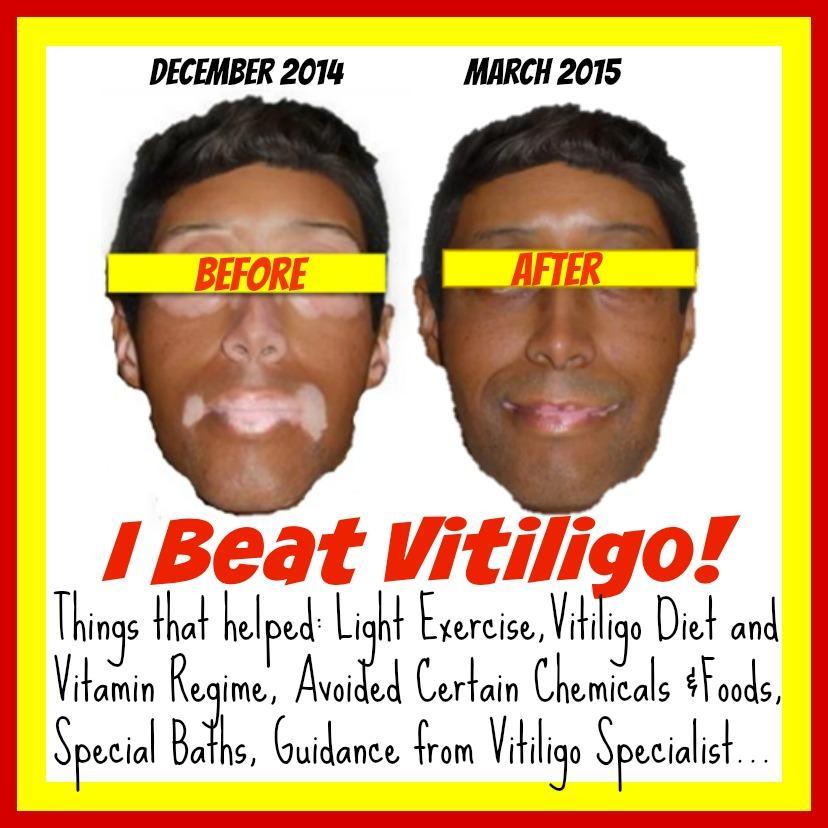 My goal is to help others overcome vitiligo as I did. With determination and the correct knowledge I believe anyone can overcome the disease.