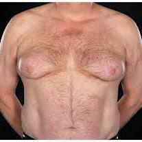 Learn about gynecomastia causes and treatment options